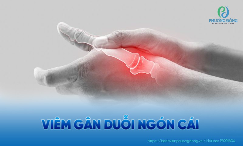 Viêm gân duỗi ngón cái: Dấu hiệu, điều trị và cách phòng ngừa