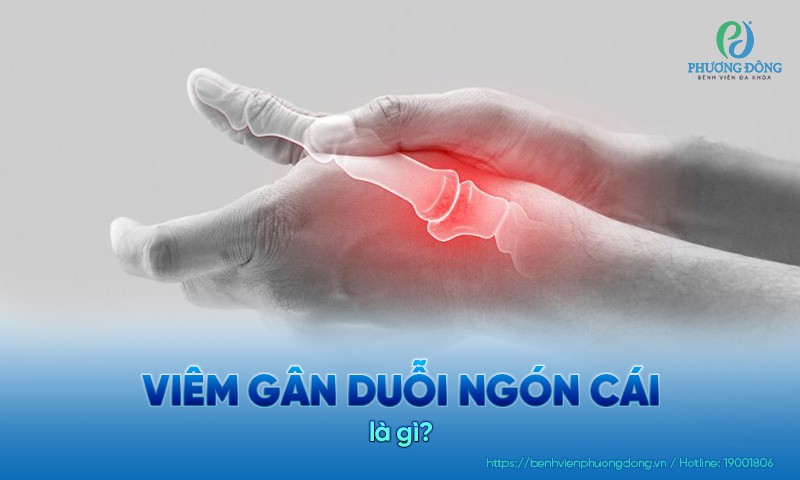 Viêm gân duỗi ngón cái là tình trạng các gân bị viêm, sưng dày và đau nhức mỗi khi cử động