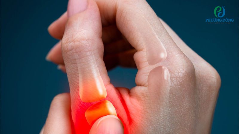 Dấu hiệu nhận biết gân duỗi ngón tay cái bị viêm