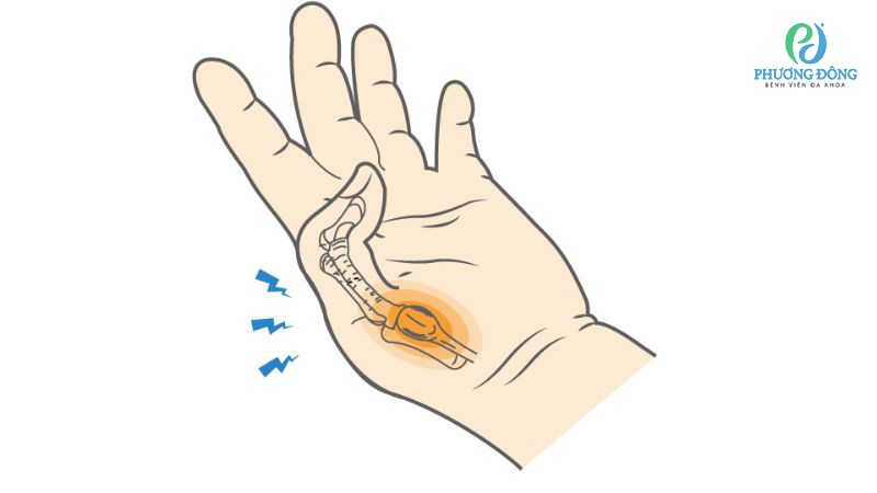 Biện pháp phòng ngừa viêm gân duỗi ngón cái