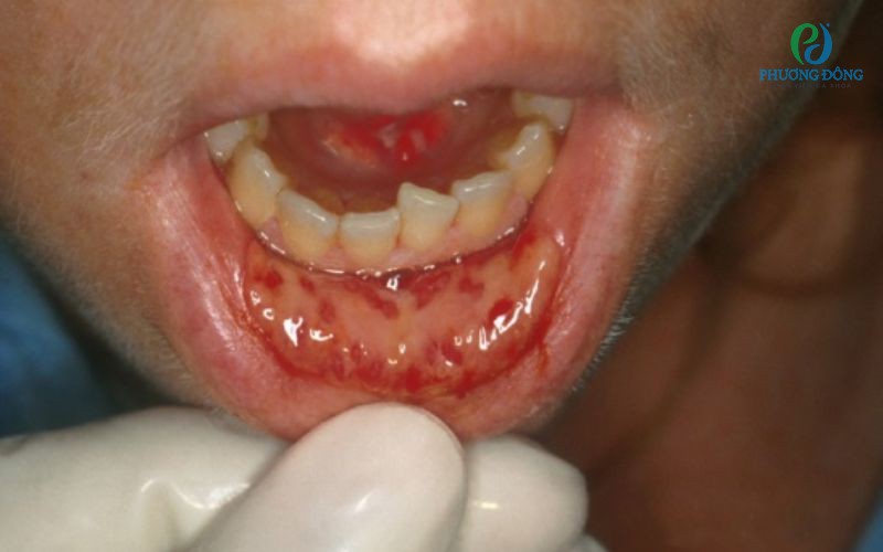Viêm nhiễm khoang miệng: Nguyên nhân, triệu chứng và cách điều trị