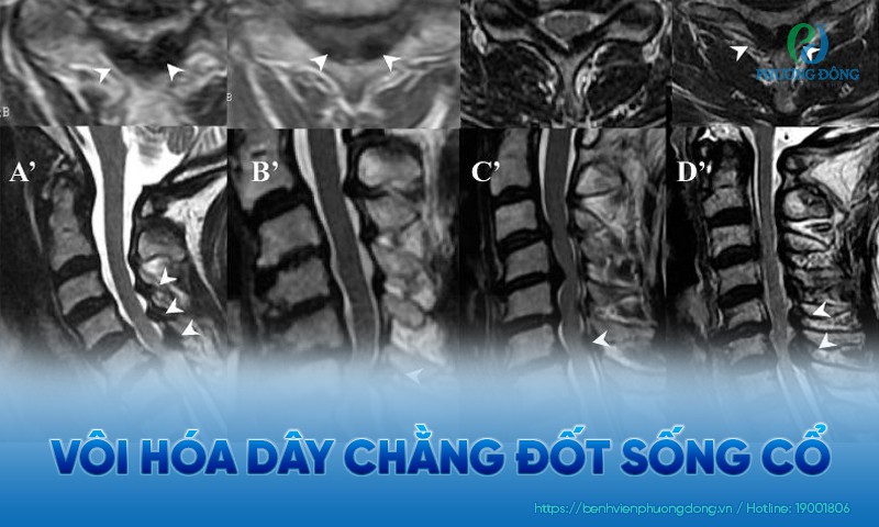 Vôi hóa dây chằng đốt sống cổ: Nguyên nhân, triệu chứng và điều trị