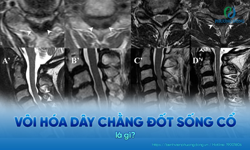 Vôi hoá dây chằng đốt sống cổ làm hạn chế chức năng vận động của người bệnh