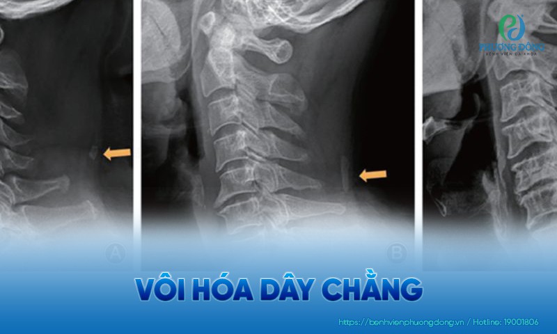 Vôi hóa dây chằng: Nguyên nhân, dấu hiệu và hướng điều trị