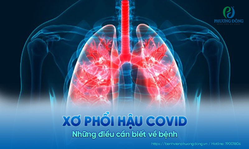 Xơ phổi hậu Covid - Những điều cần biết về bệnh Xơ phổi hậu Covid - Những điều cần biết về bệnh