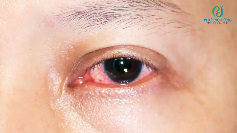 Bệnh nhân đau mắt đỏ nên ngủ một ngày 7 - 8 tiếng để nhanh chóng hồi phục