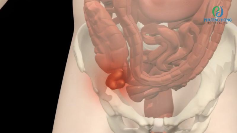 Cơn đau ruột thừa có thể diễn ra âm ỉ trước khi lan xuống hố chậu phải