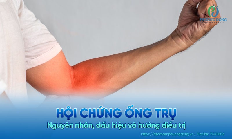 Hội chứng ống trụ: Nguyên nhân, dấu hiệu và hướng điều trị