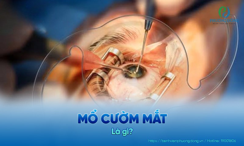 Mổ cườm mắt: Chỉ định, phương pháp và quy trình kỹ thuật