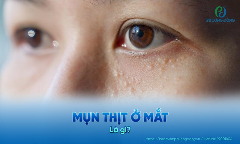 Mụn thịt ở mắt: Nguyên nhân, triệu chứng và hướng điều trị