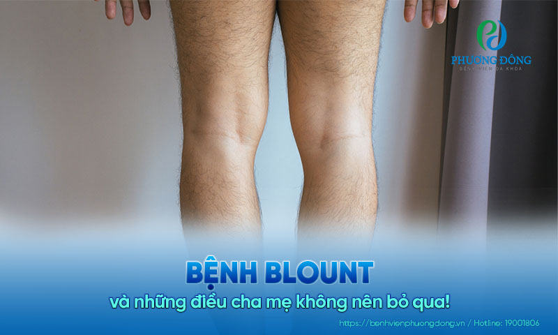 Bệnh Blount và những điều cha mẹ không nên bỏ qua!
