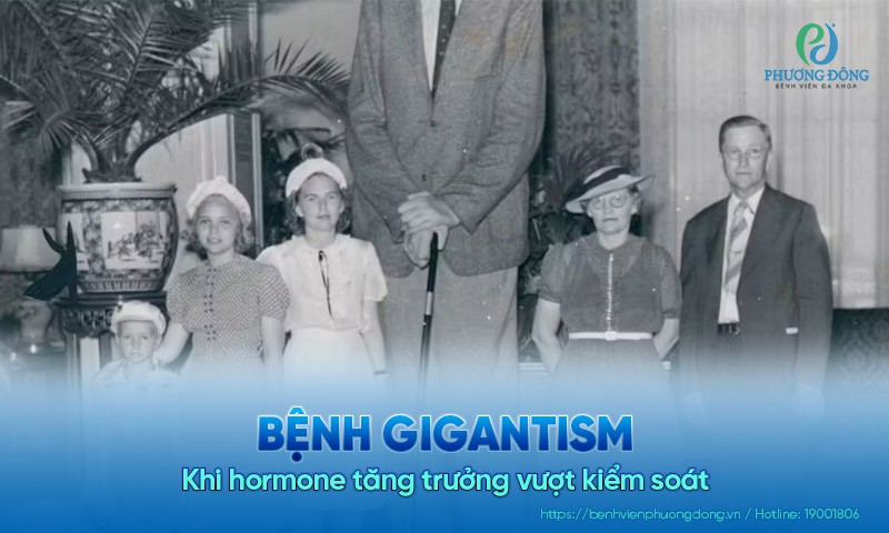 Bệnh Gigantism: Khi hormone tăng trưởng vượt kiểm soát