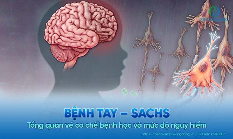 Bệnh Tay – Sachs: Tổng quan về cơ chế bệnh học và mức độ nguy hiểm