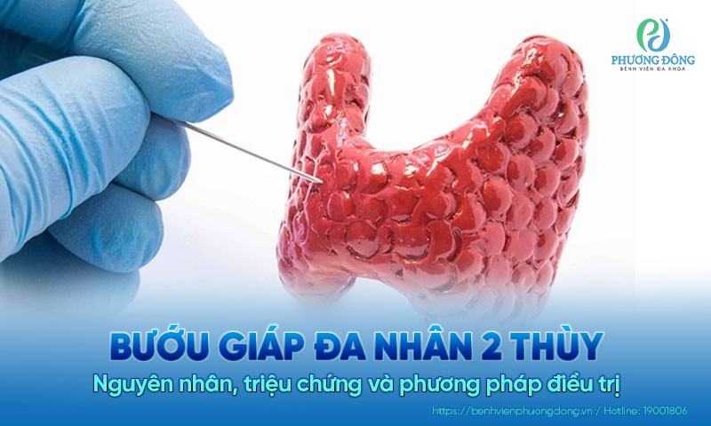 Bướu giáp đa nhân 2 thùy: Nguyên nhân, triệu chứng và phương pháp điều trị