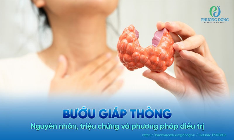 Bướu giáp thòng: Nguyên nhân, triệu chứng và cách điều trị