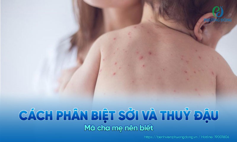 Cách phân biệt sởi và thủy đậu