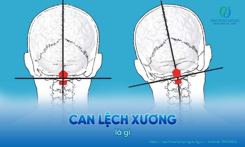 Can lệch xương là gì? Nguy cơ tiềm ẩn và phương pháp phẫu thuật