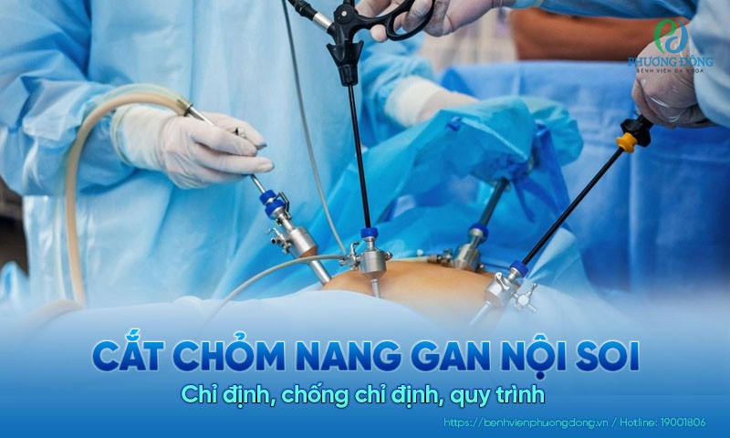 Cắt chỏm nang gan nội soi: Chỉ định, chống chỉ định, quy trình 