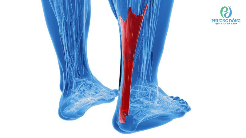 Viêm gân Achilles làm suy giảm chức năng vận động của bắp chân