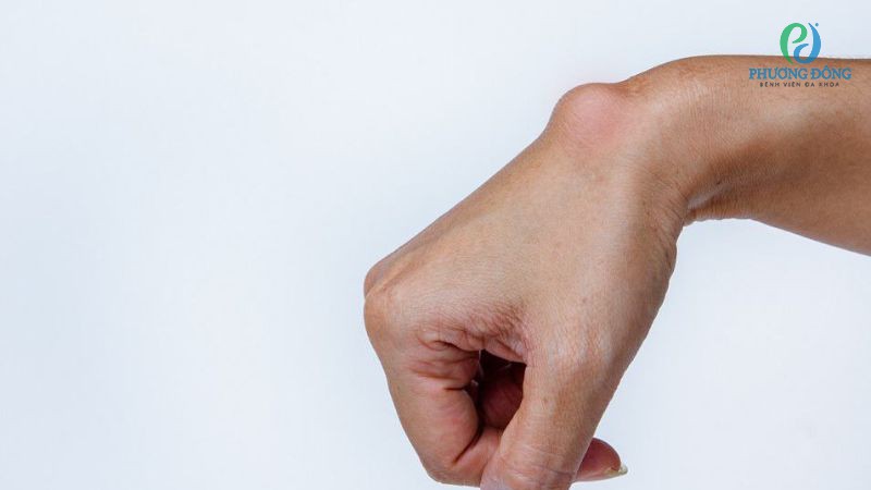 U nang hoạt dịch cổ tay hình thành sau thời gian dài sử dụng lực ở cổ tay