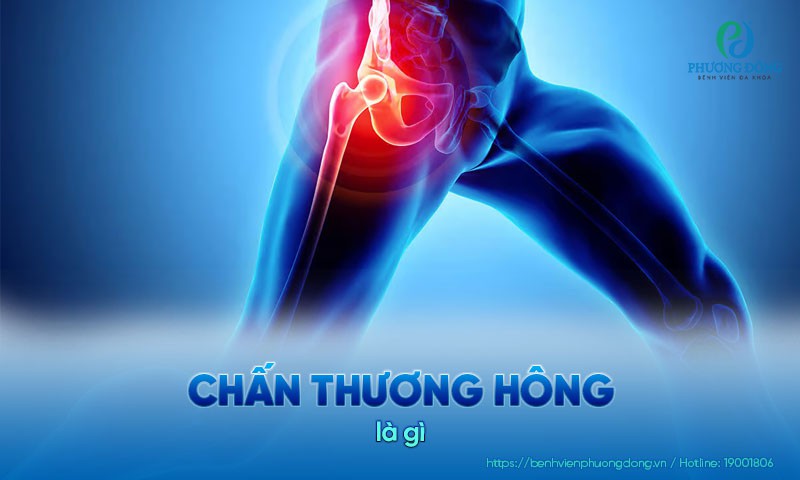 Chấn thương hông: Nguyên nhân, chẩn đoán và hướng điều trị