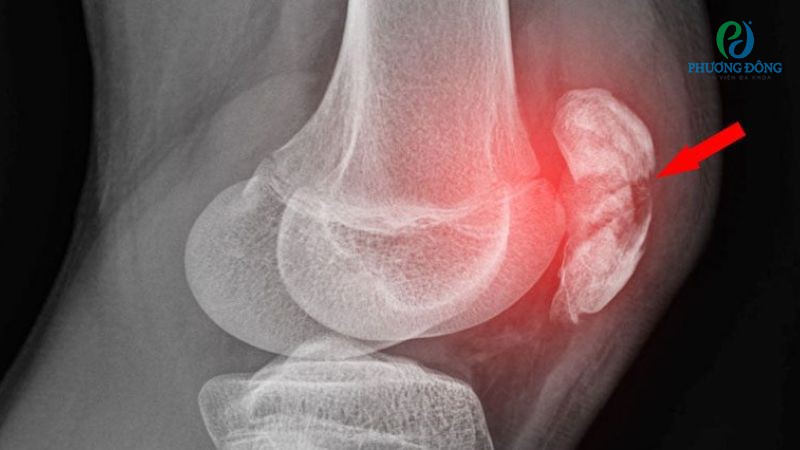 Chấn thương xương bánh chè khi chơi bóng rổ