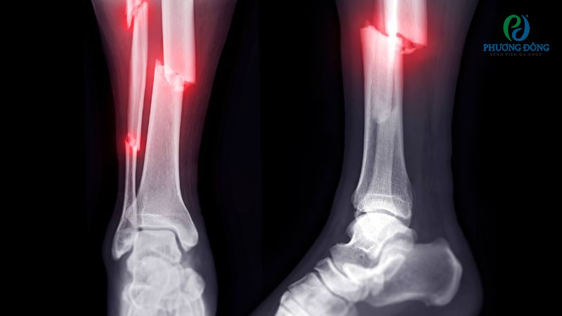 Gãy xương là một dạng chấn thương phổ biến, thường do chịu lực tác động mạnh