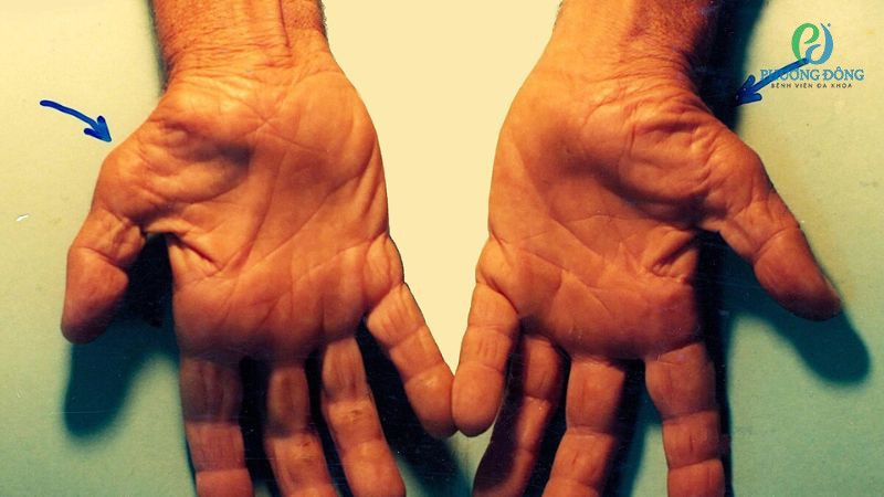 Hội chứng ống cổ tay xuất hiện sau thời gian dài dây thần kinh ở đây bị chèn ép, kích thích