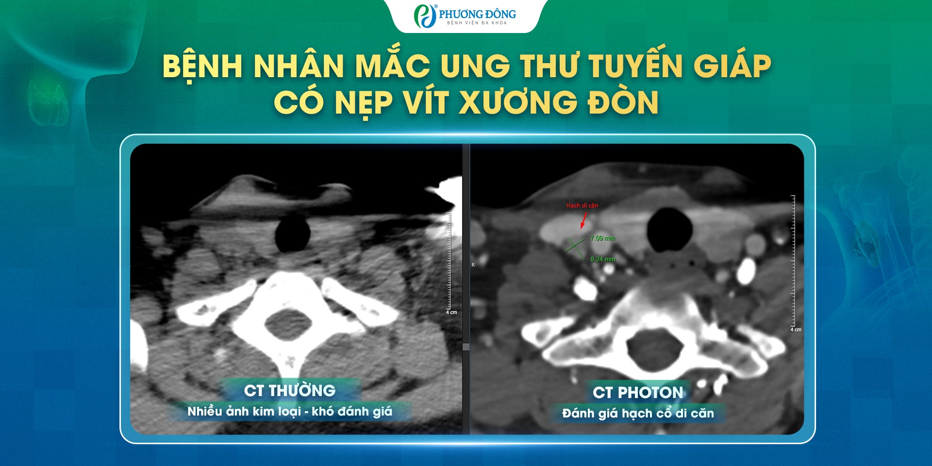 CT Photon NAEOTOM Alpha - ĐÁNH GIÁ CHÍNH XÁC HẠCH CỔ DI CĂN 