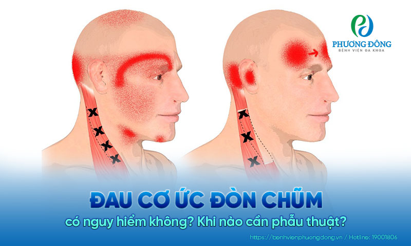 Đau ức cơ đòn chũm có nguy hiểm không? Khi nào cần phẫu thuật?