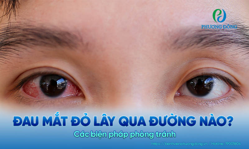 Đau mắt đỏ lây qua đường nào? Các biện pháp phòng tránh