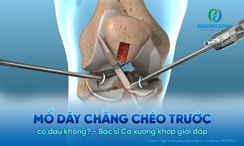 Bác sĩ Cơ xương khớp giải đáp: Mổ dây chằng chéo trước có đau không?