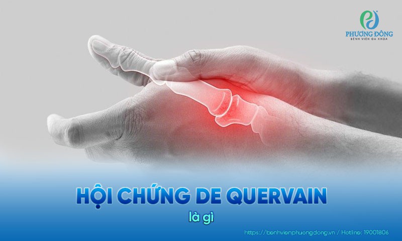 Hội chứng De Quervain: Dấu hiệu, nguyên nhân và hướng điều trị