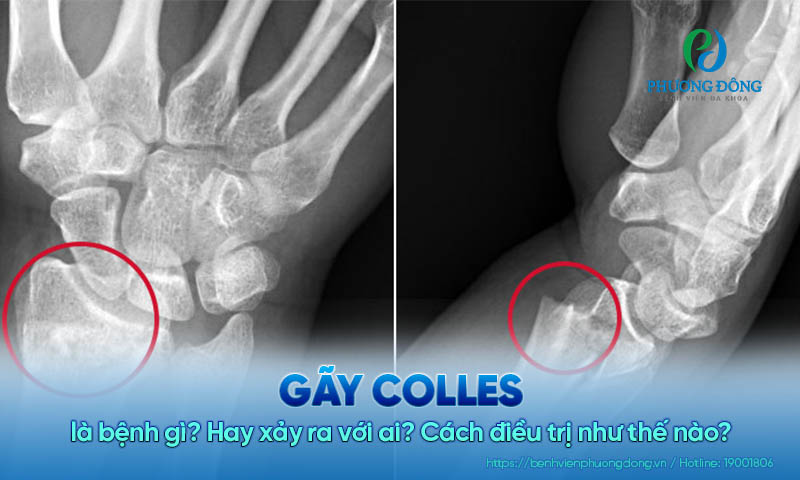 Gãy Colles là bệnh gì? Hay xảy ra với ai? Cách điều trị như thế nào?