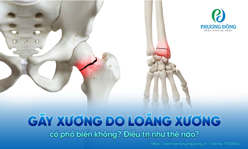 Gãy xương do loãng xương có phổ biến không? Điều trị như thế nào?
