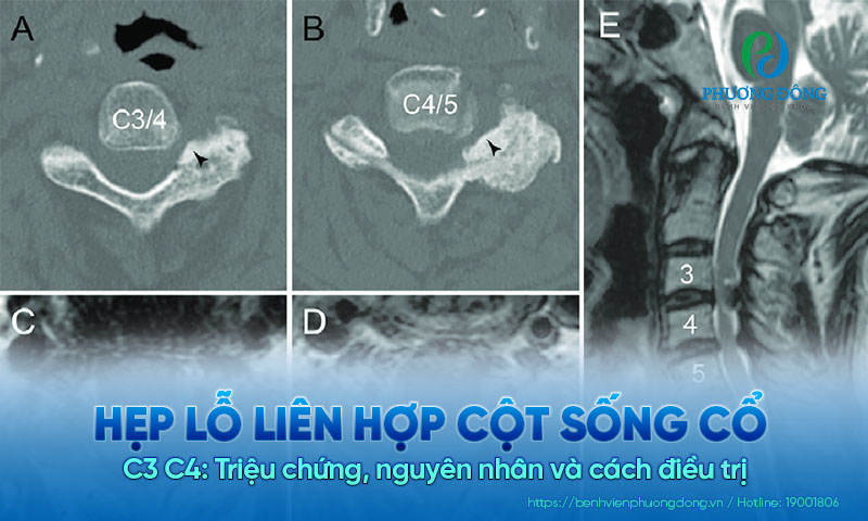 Hẹp lỗ liên hợp cột sống C3 C4: Triệu chứng, nguyên nhân và cách điều trị