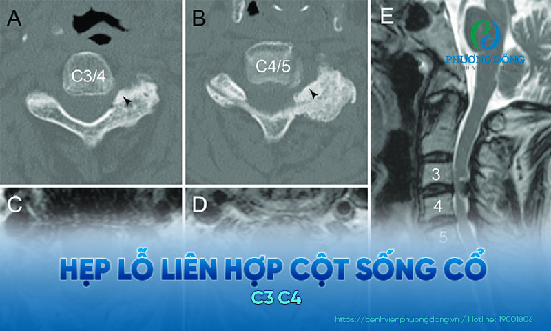 Lỗ liên hợp giữa đốt sống cổ C3 và C4 có thể bị thu hẹp