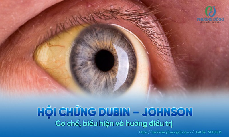 Hội chứng Dubin – Johnson: Cơ chế, biểu hiện và hướng điều trị