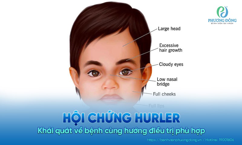 Hội chứng Hurler: Khái quát về bệnh cùng hướng điều trị phù hợp