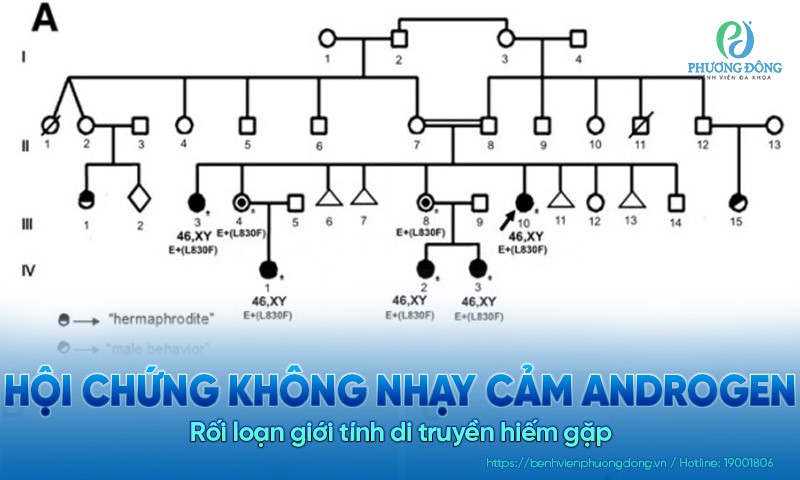 Hội chứng không nhạy cảm Androgen: Rối loạn giới tính di truyền hiếm gặp