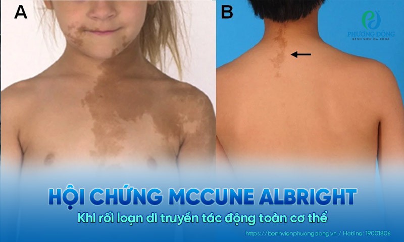 Hội chứng McCune Albright: Khi rối loạn di truyền tác động toàn cơ thể