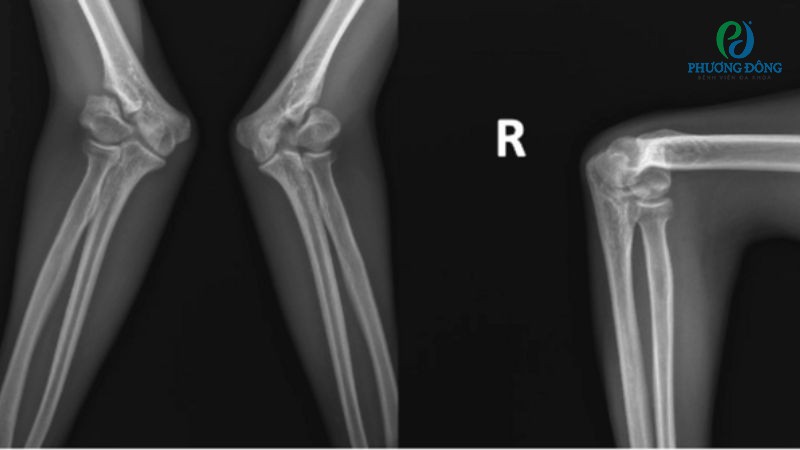 Chấn thương và bệnh lý là hai nguyên nhân hàng đầu làm chèn ép dây thần kinh trụ