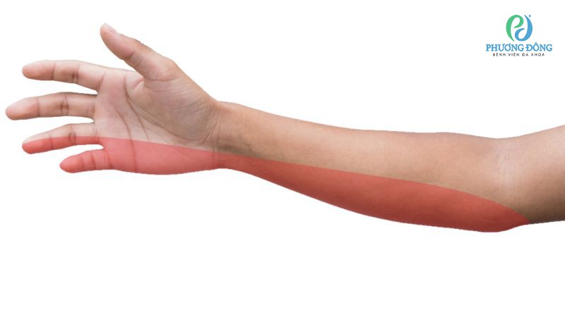 Triệu chứng cảnh báo dây thần kinh ống trụ bị chèn ép