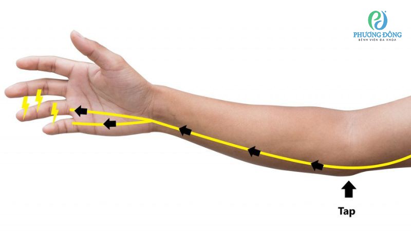 Hai hướng can thiệp điều trị hội chứng ống trụ