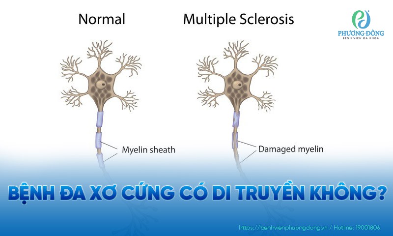 Bệnh đa xơ cứng có di truyền không?