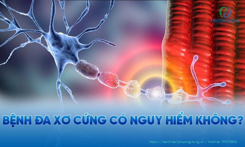 Bệnh đa xơ cứng có nguy hiểm không?