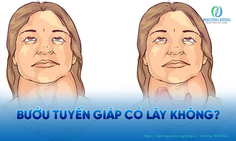 Bướu tuyến giáp có lây không?