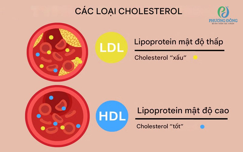 Liporotein tốt và Lipoprotein xấu