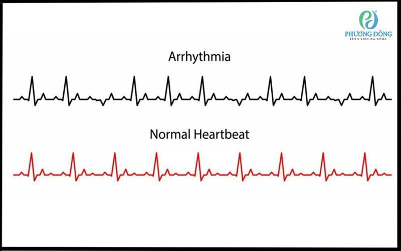 Nhận biết tình trạng rối loạn nhịp tim và nhịp tim bình thường