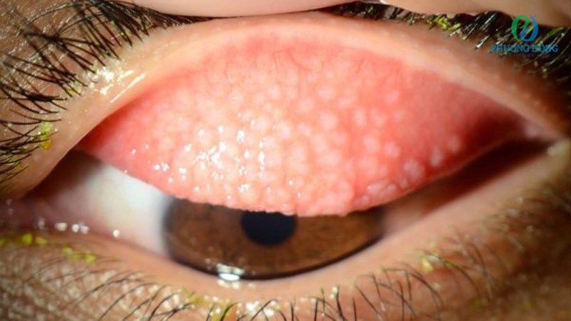 Đau mắt hột là một trong những bệnh lý vùng kết mạc thường gặp
